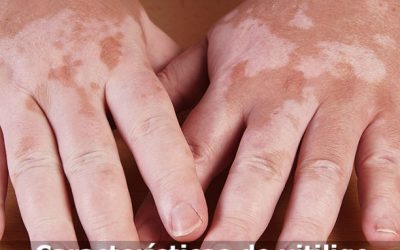Características do vitiligo