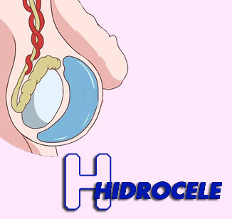 Hidrocele: o que é e tratamento