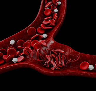 Anemia falciforme: o que é, prevenção e tratamento