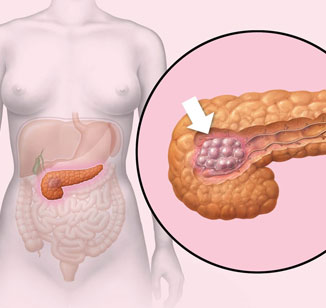 Câncer de pâncreas: causas, sintomas e tratamento