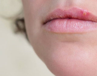 Câncer de boca: prevenção e diagnóstico precoce